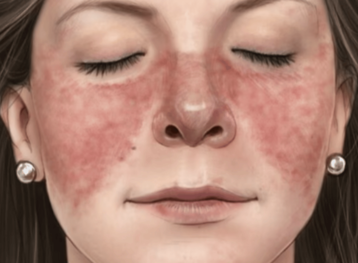 <p>butterfly shaped rash on the face</p>