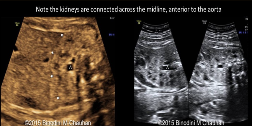 <p>an abn of r<strong>enal fusion</strong> where the <strong>lower pole</strong> of kidneys are connected <strong>across</strong> the <strong>midline</strong> of abd called</p><p>a) horseshoe kidney</p><p>b) epispadias</p><p>c) cross fused renal ectopia</p><p>d) persistent cloaca</p>