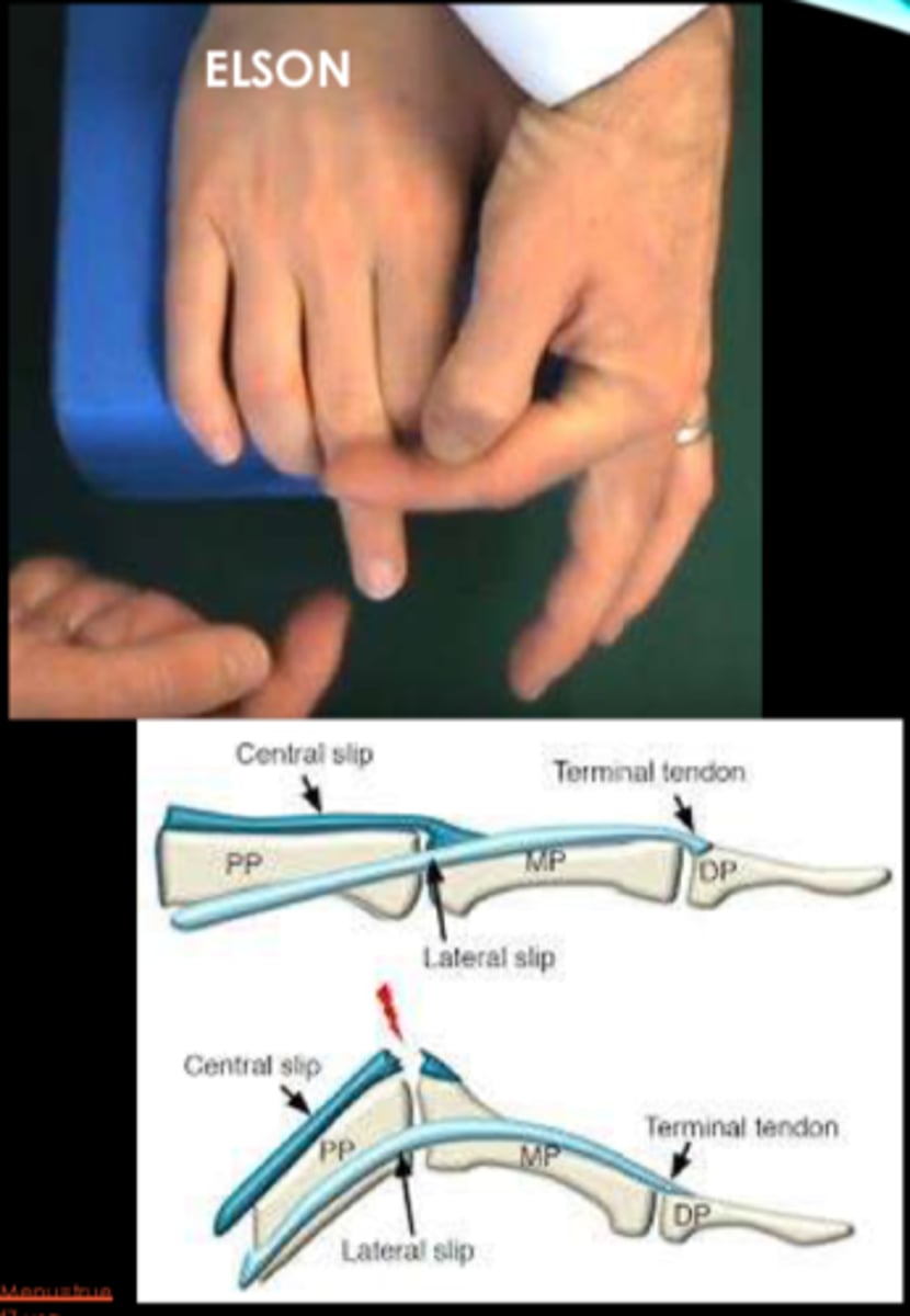 <p>Assesses rupture of central slip; +test: absence of extension force at PIP and fixed extension at DIP</p>