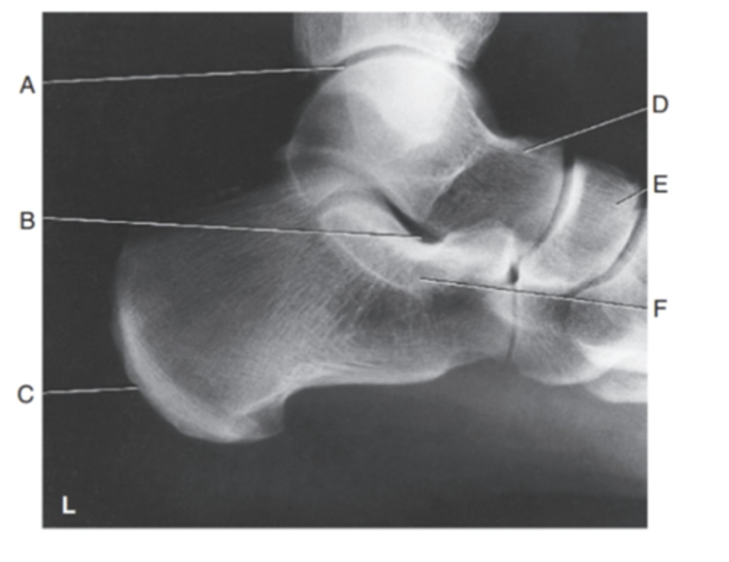 <p>(LATERAL CALCANEUS) what is A?</p>