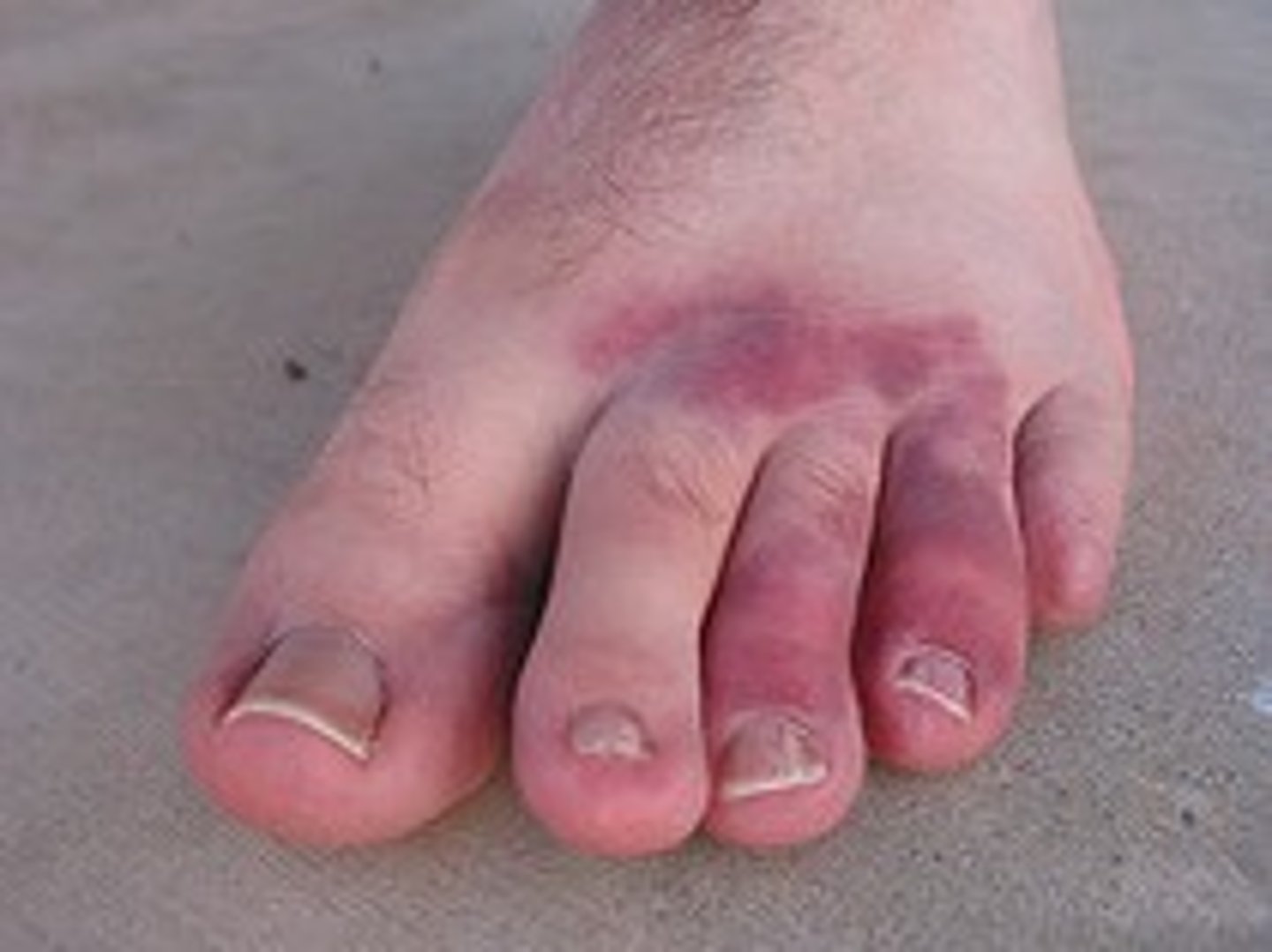 <p>A "bruise-type" injury without a fracture or break in the skin</p>