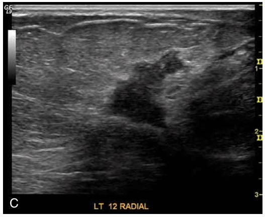 <p>If a mass measures longer in the anteroposterior dimension (height) than in the transverse or sagittal plane (width), it has a vertical orientation, is usually described as ________ and is highly suspicious for malignancy </p>