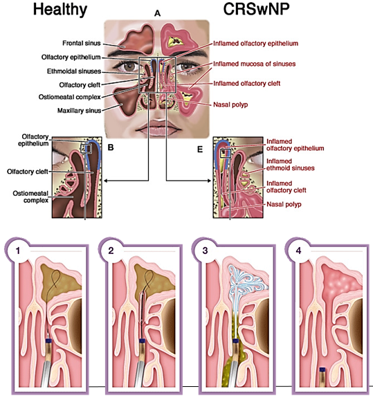 <p>The respiratory mucosa reacts to stimuli (e.g., virus) by <strong>producing mucus and attracting inflammatory mediators</strong>, leading to congestion, swelling, and blockage, which can encourage <strong>secondary bacterial growth.</strong></p>