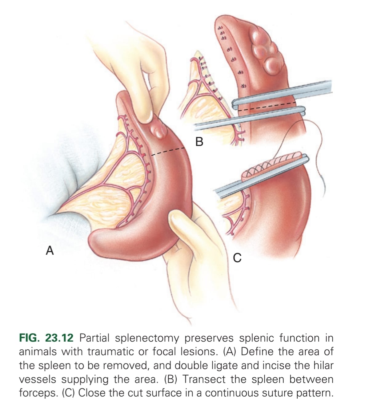 <p>Elevate spleen from abdomen → Ligate or seal hilar vessels in area → may use automatic stapling device to separating parenchyma, or digital pressure (not to destroy capsule) → haemostatic clamp across separated parenchyma &amp; second clamp 1-2 cm distally, &amp; transect midway between clamps → Appose capsule w/ continuous absorbable material. A second line of continuous or interrupted mattress may be used to gain a more haemostatic effect.</p>