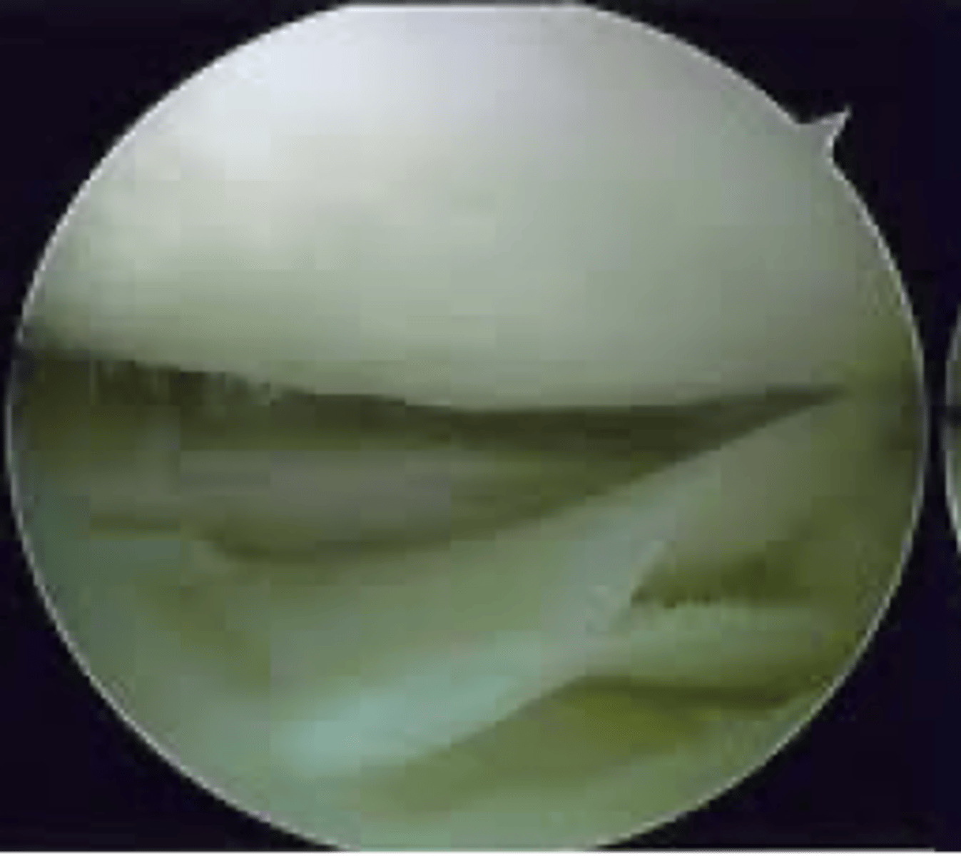 <p>meniscus removal</p><p>- can be done with camera?</p>