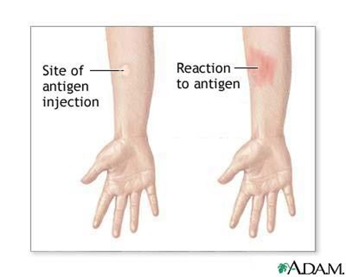 <p>Skin test or blood test --&gt; if positive, sputum smear and x-ray to confirm</p>