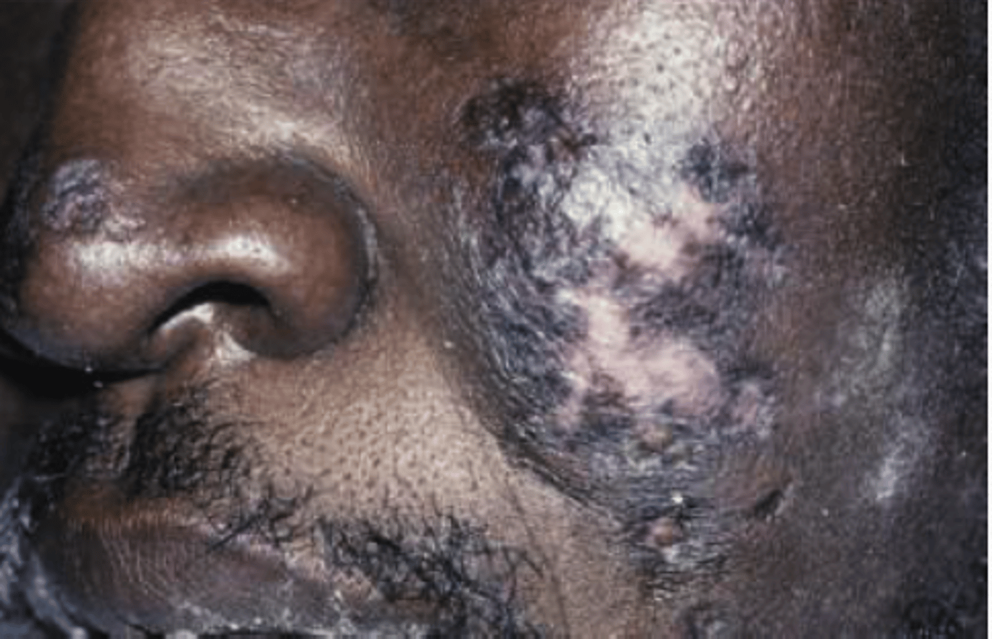 <p>Hint: skin lesions present as discoid lupus erythematous</p>