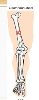 <p>Several breaks result in many small pieces between two large bone segments </p>