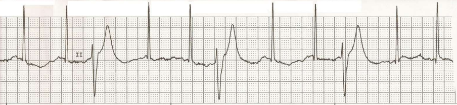 <p>a heart rhythm disorder where after every two normal heartbeats is a premature ventricular contraction (PVC) </p>
