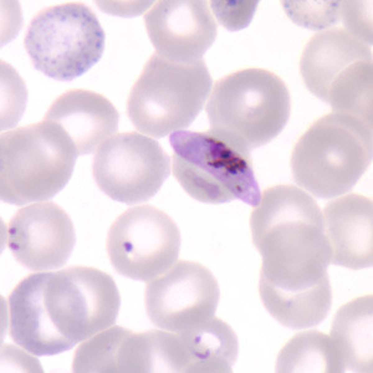 <p>Name the Plasmodium species based on the following information: No persistent liver stage or relapse; blood smear shows multiple ring forms and crescent-shaped gametes; irregular febrile pattern; associated with cerebral malaria</p>