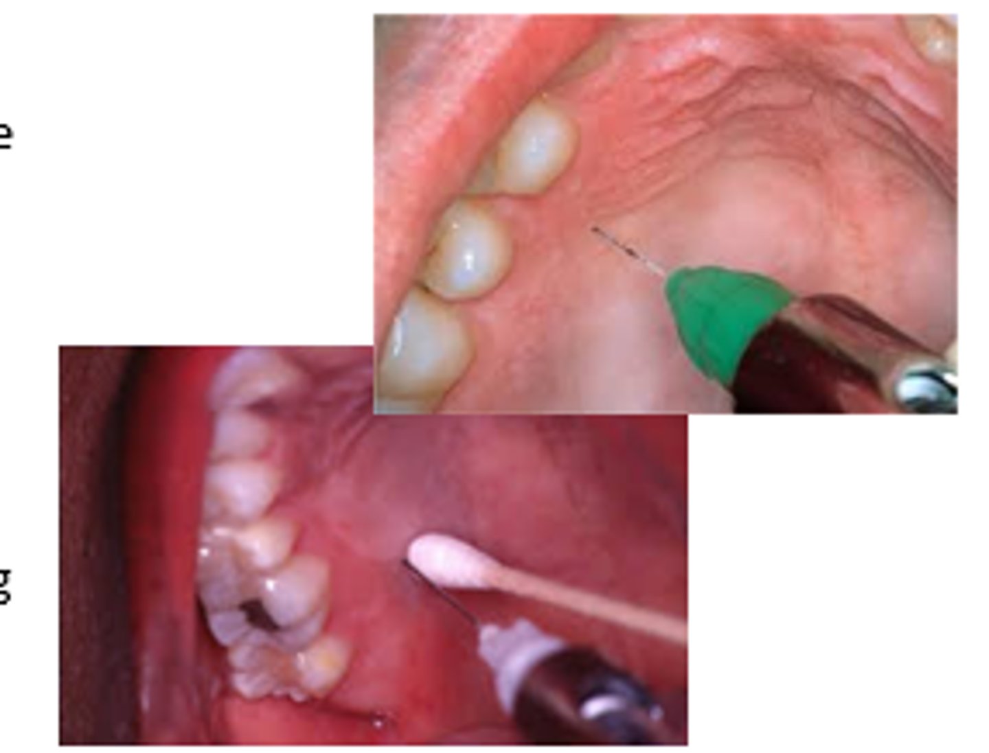 <p>when treatment requires anesthesia of the palate</p>
