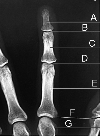 The head of the metacarpal is indicated by the letter: