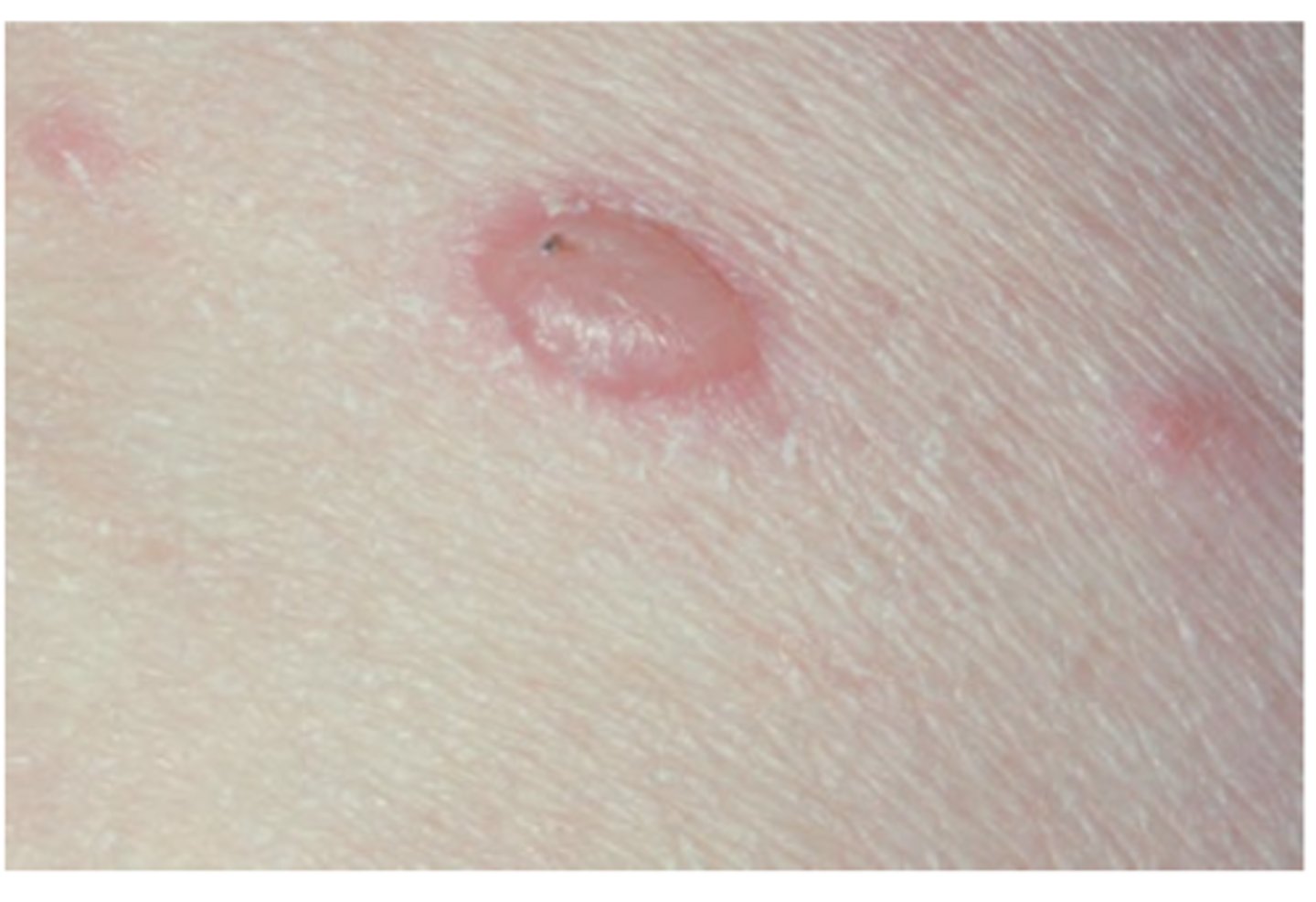 <p>Hint: Flaccid vesicles & bullae that rupture quickly</p>