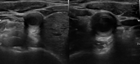 <p>A 33-year-old women comes in complaining of worsening headaches that can even lead to fainting episodes. She has a history of high blood pressure.&nbsp;</p><ol><li><p>What can be seen sonographically?</p></li><li><p>What pathology can be assumed here?</p></li></ol><p></p>