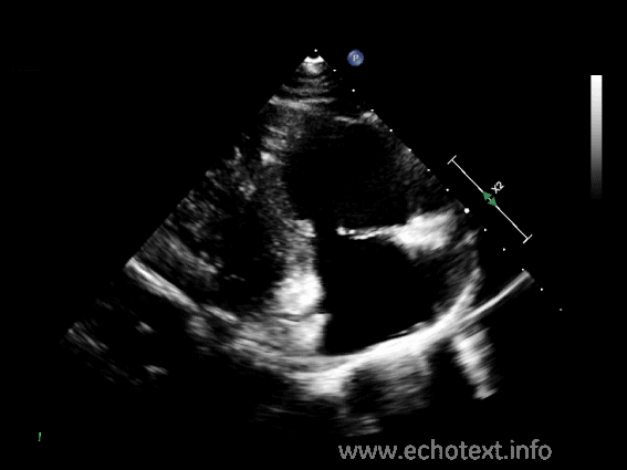 <p>From the PSLA view, angle the beam medial and inferior towards the right hip.</p>