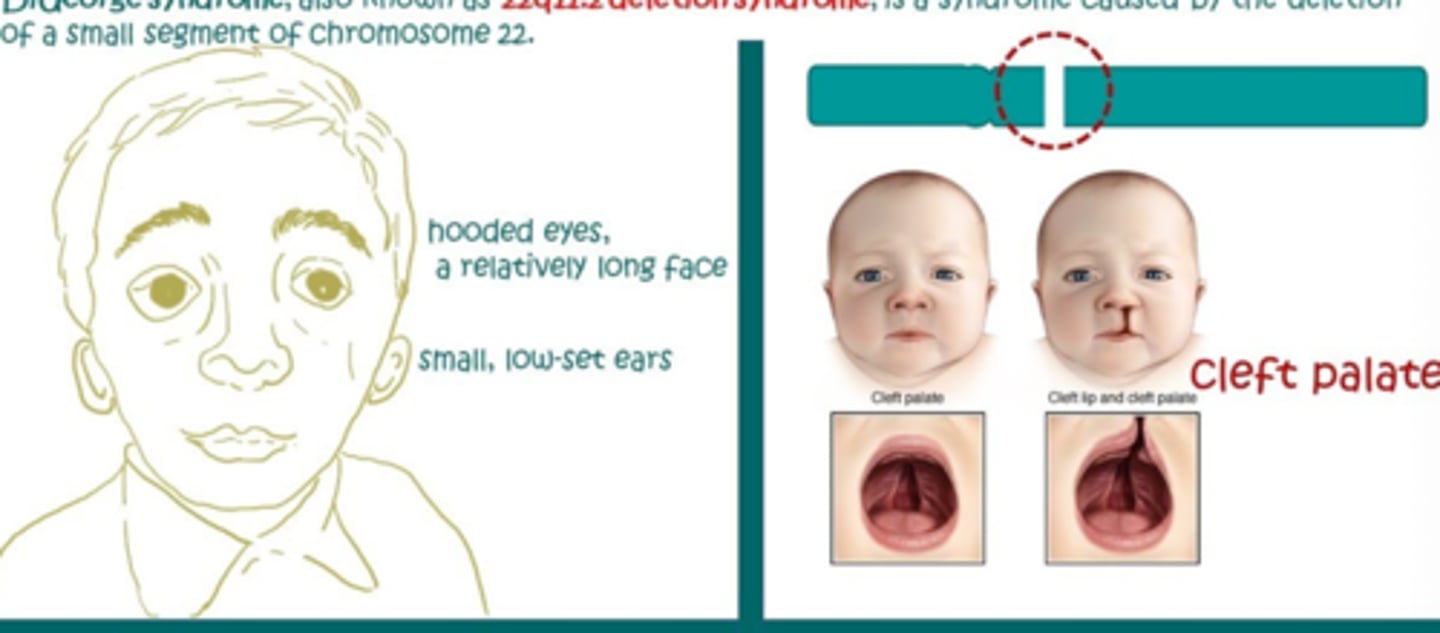 <p>-22q11.2 deletion syndrome </p><p>-parathyroid glands fail to develop properly or absent </p><p>Sx</p><p>-cardiac anomalies, abnormal facies, thymic hypoplasia, cleft palate, hypocalcemia</p><p>-CATCH-22 </p><p>Tx</p><p>-lifelong calcium and Vit D </p><p>-regular monitoring of calcium </p><p>-thymic transplant </p>