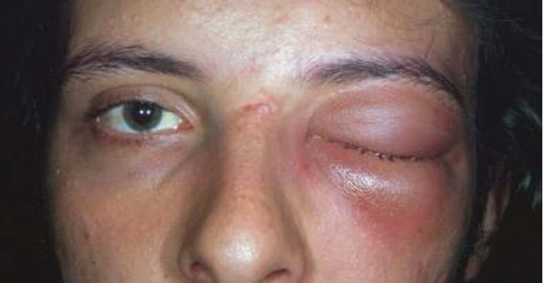 <p>infection of orbit posterior to orbital septum</p>