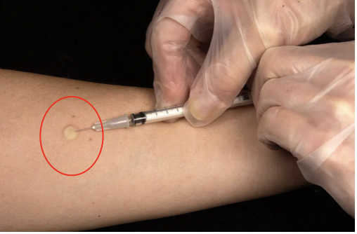 <p><span>How would you document this spot on the patient?</span></p><p></p>