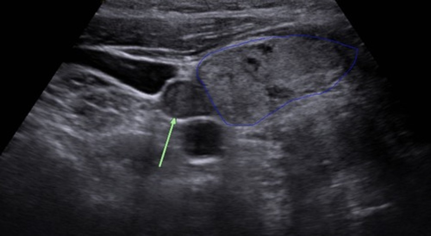 <p>Extremely elevated levels of PTH and calcium levels</p><p>Caused by presence of an adenoma</p>