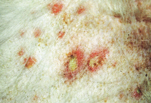 <p><span>Bullous Impetigo</span></p>