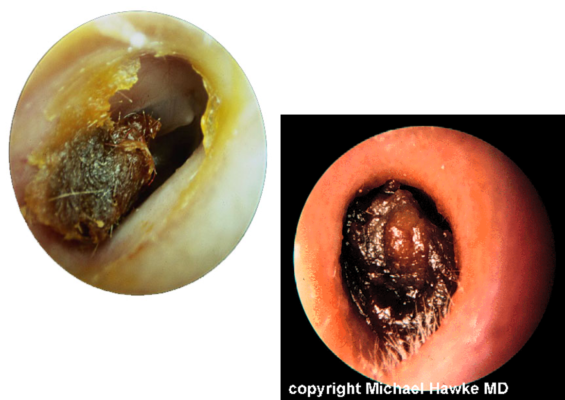 <p>yellow to brown sticky hard cerumen obscuring the drum </p>