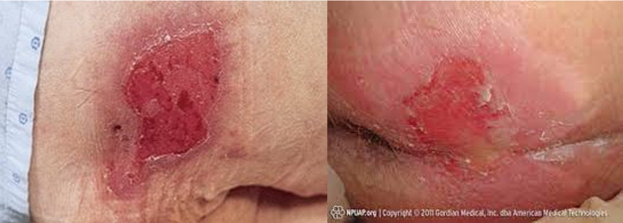 <p><strong>What stage pressure injury?</strong></p><ul><li><p>partial thickness skin loss that does not go deeper than dermis</p><ul><li><p><strong>NO SC tissue exposure; </strong>no granulation tissue, slough or eschar present</p></li></ul></li><li><p>can include intact or ruptured blisters</p></li><li><p><u>heal</u>: tissue regeneration</p></li></ul><p></p>