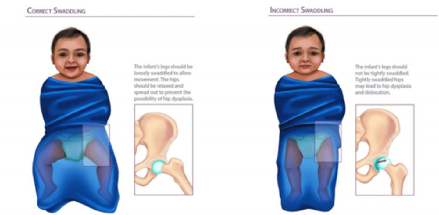 <p>Incorrect swaddling can increase hip dysplasia risk </p>