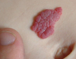 <p>Hoe heet dit klinisch beeld?</p>