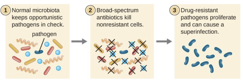 <p><span>A </span>secondary infection<span> that occurs when </span>broad-spectrum antibiotics eliminate normal protective microbiota<span>. This allows </span>resistant or opportunistic pathogens to overgrow and cause disease<span>. </span></p><p><span>For example, killing </span><em>lactobacilli</em><span> in the vagina with a broad-spectrum cephalosporin used for a UTI can lead to an overgrowth of </span><em>Candida albicans</em><span>, causing a vaginal yeast infection</span></p>