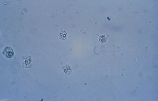 WBCs with acetic acid nuclear enhancement