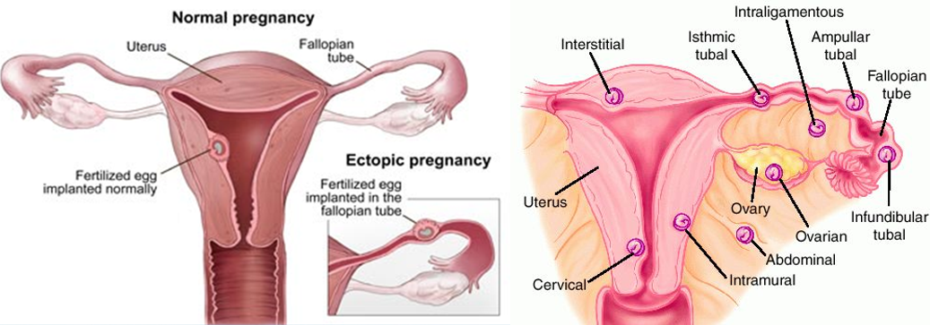 <ul><li><p>Implantation of a fertilized ovum in a site other than the endometrial lining of the uterus.</p></li><li><p><strong>The egg can implant in the</strong>:</p><ul><li><p>Fallopian tube</p></li><li><p>Ovary</p></li><li><p>Peritoneal cavity</p></li><li><p>Cervix</p></li></ul></li><li><p><strong>Risk Factors</strong>:</p><ul><li><p>Tubal obstruction/damage</p></li><li><p>Delayed tubal transport</p></li><li><p>Congenital anomalies</p></li><li><p>Altered hormonal status</p></li><li><p>Smoking</p></li><li><p>AMA</p></li></ul></li></ul><p></p>