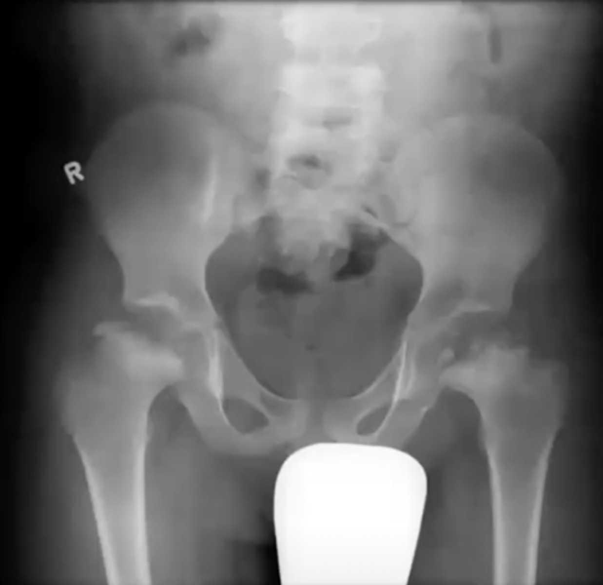 <p>What is this?</p><p>Ex. Pt is 3-12 yo Male with (+) Trendelenburg</p>