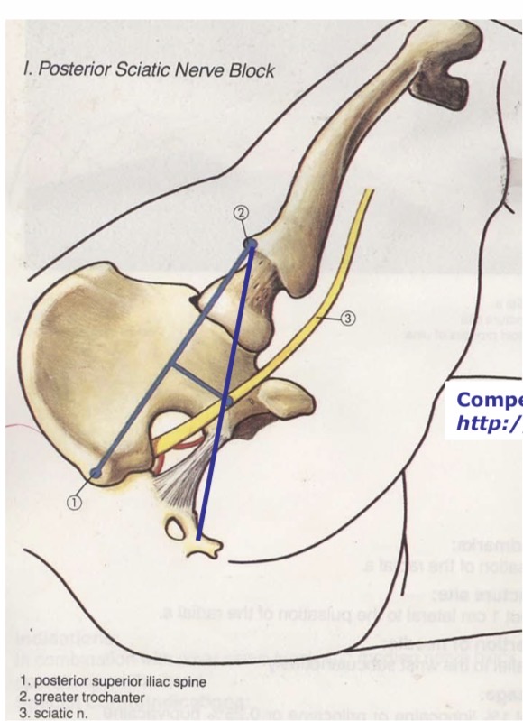 <p>n. ischiadicus užpakalinė sėdmeninė blokada anatominiai orientyrai </p>