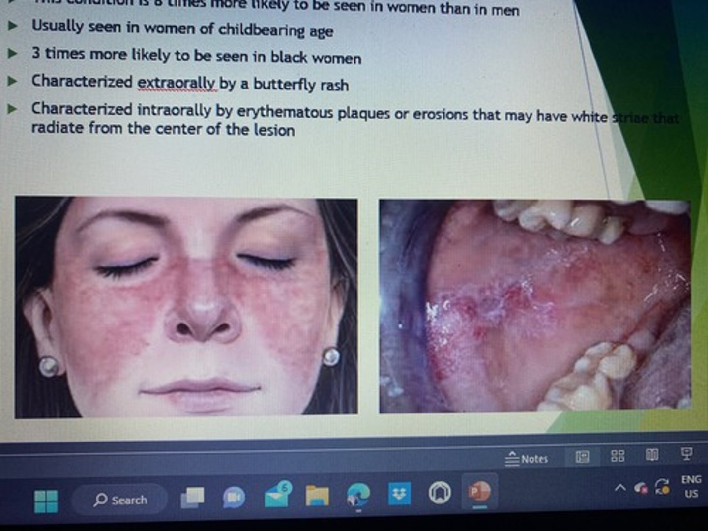 <p>This condition is 8 times more likely to be seen in women than in men.</p><p>Usually seen in women of childbearing age.</p><p>3 times more likely to be seen in clack women.</p><p>Characterized extraorally by a butterfly rash.</p><p>Characterized intractable by erythematous plaques or erosions that may have white striae that radiate from the center of the lesion.</p>