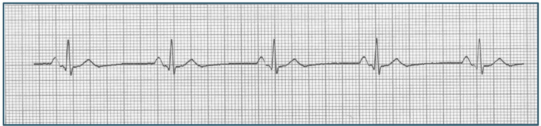 <p>Electrocardiogram (ECG or EKG)</p>