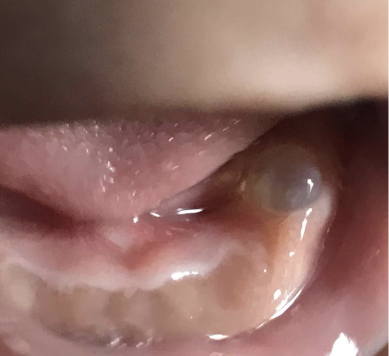 <p>The mother of a 1 month old baby has a concern of a bubble in the mouth of her kid. The clinical image is shown below. There is no pain or any other symptoms. Provide diagnosis and synonym</p>