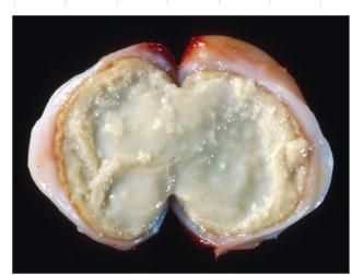 <p>Cellular and architectural detail of tissue is lost usually due to bacteria</p><p>Looks like a soft cheese </p>