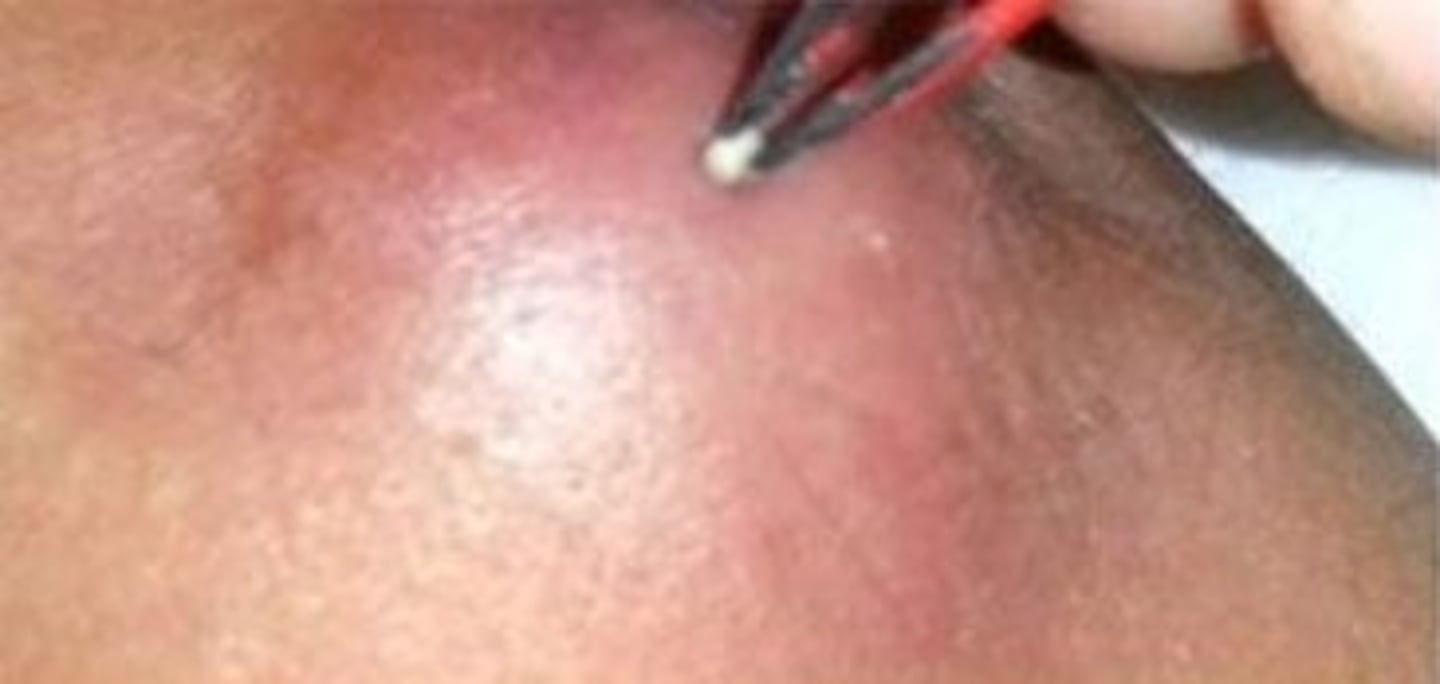 <p>-Sac under the skin filled with sebum or oil from a sebaceous gland</p><p>-This can grow to a large size and may need to be excised</p>