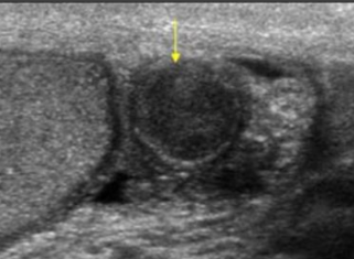 <p>sperm granuloma</p>