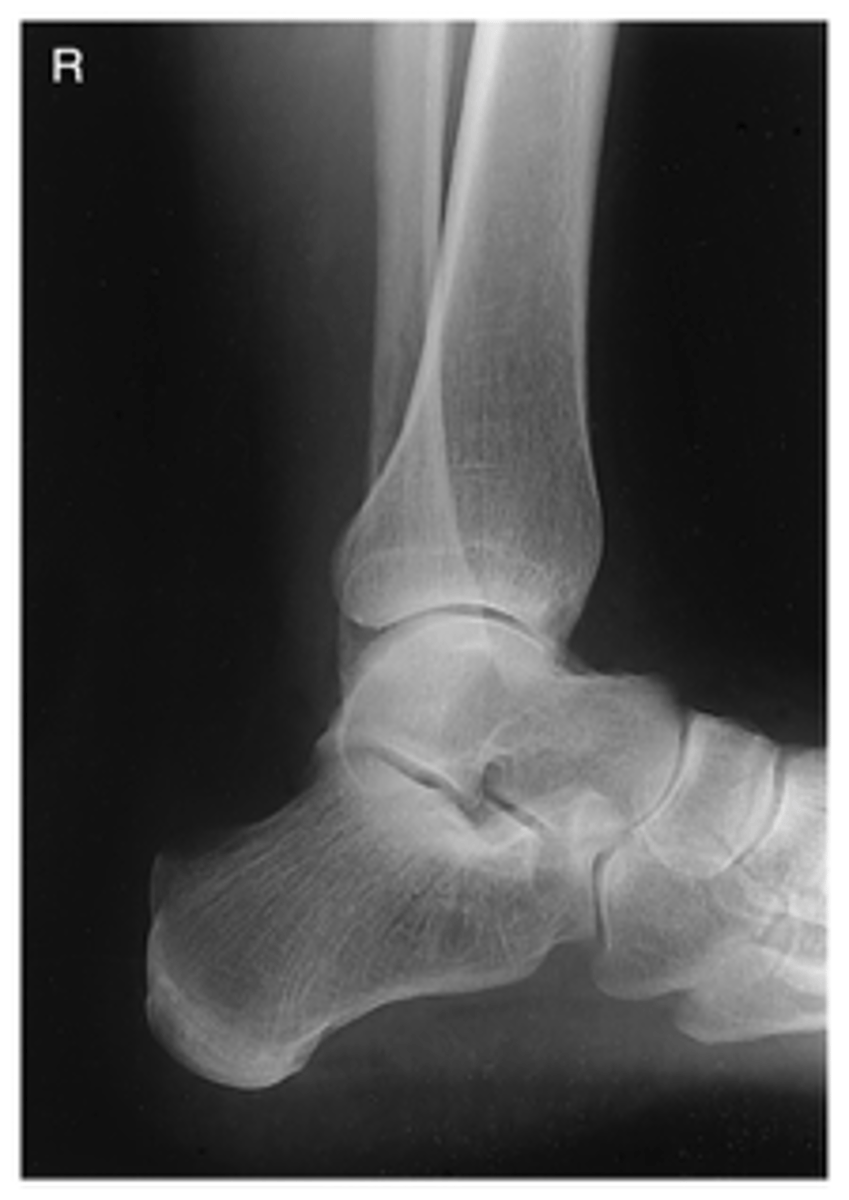 <p>- CR Centered to Medial Malleolus</p><p>- Entire talus and calcaneus visualized</p><p>- Lateral malleolus superimposed over posterior half of tibia</p><p>- Optimal exposure factors</p>