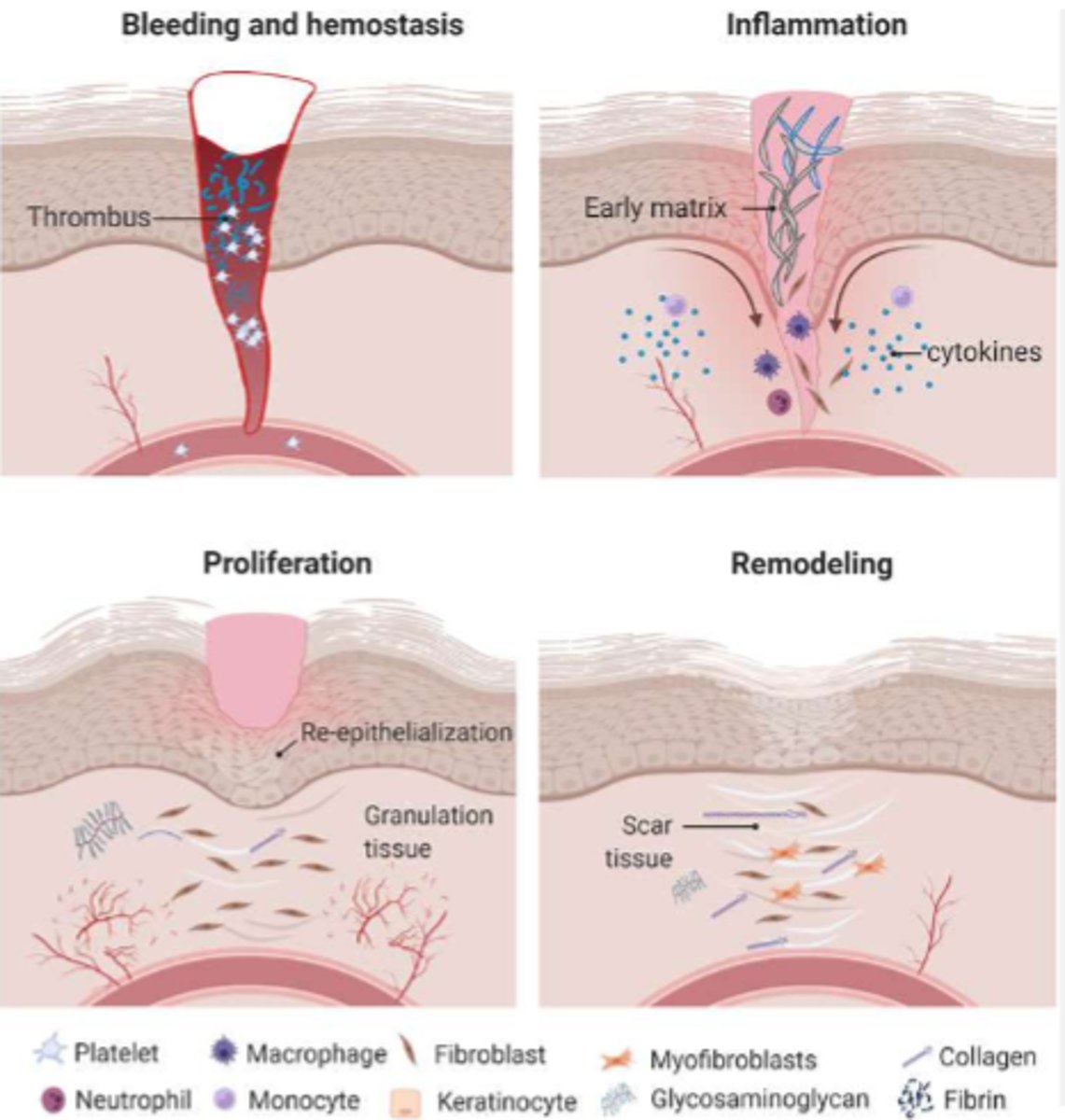 <p>0-3 days: hemostasis</p><p>- insult to skin</p><p>- vasoconstriction occurs to stop bleeding</p><p>- clot formation</p><p>1-25 days: inflammation</p><p>(4 days)</p><p>- cytokines released to activate cells that breakdown foreign material/bacteria</p><p>(macrophages, T cells, neutrophils, etc.)</p><p>- vasodilation of capillaries</p><p>- redness, edema, warmth, peripheral sensitization</p><p>1-25 days: proliferation</p><p>(3-21 days)</p><p>- reaction of the body to start wound closure</p><p>- collagen (type III) synthesis, capillary proliferation, granulation formation</p><p>- TISSUE IS FRAGILE</p><p>20-365 days: maturation/remodeling</p><p>- closed wound but still healing</p><p>- skin shrinkage</p><p>- final tensile strength 80% of original</p>