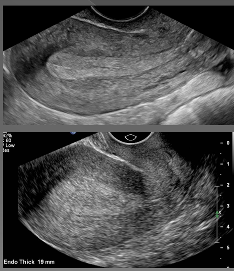 <p>What is endometrial hyperplasia?</p>