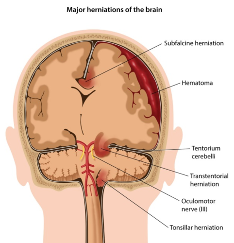 <p>-Uncus of the temporal lobe is displaced downward Creates pressure on CN III, posterior cerebral artery, and RAS -temporal lobe moves through the tentorial notch -causes fixed, blown pupils from CN III pressure</p>