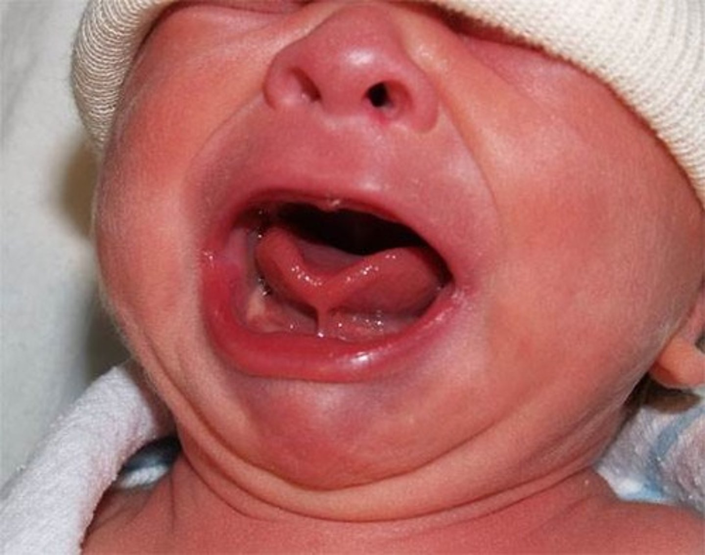 <p>Also called TONGUE-TIED. Short, lingual frenulum, fixed to tongue tip and floor of mouth and gums, limits mobility and speech. This is COMMON in newborns.</p>