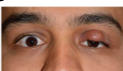 <p>mechanical ptosis</p>