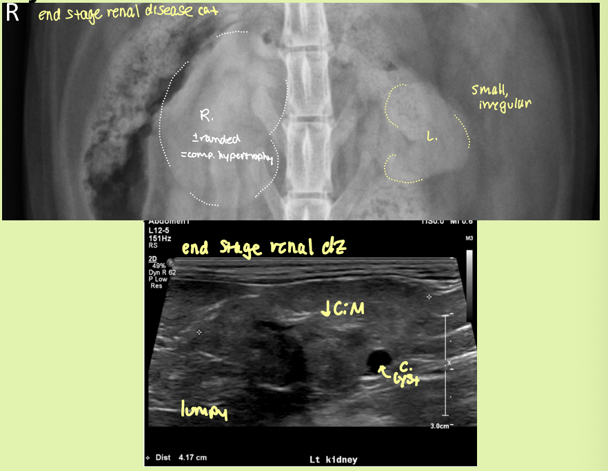 <p>end stage kidneys</p>
