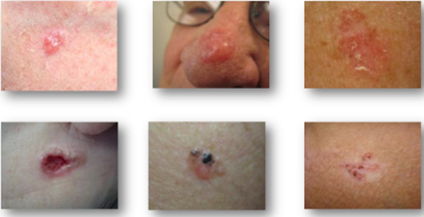 <p>most skin tumors are benign (not cancerous) and do not metastasize (spread); risk factors 1. overexposure to UV radiation 2. frequent irritation of skin; prevention by limiting sun exposure and some skin lotions contain enzymes that can repair damaged DNA</p>