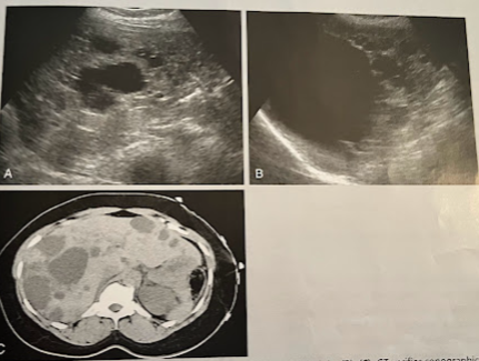 <p>A 55 year old woman underwent an abd. sonogram b/c of a feeling of fullness in her abd. The liver demonstrated multiple anechoic lesions, some w/irregular walls and many w/acoustic enhancement. A f/u CT was ordered that confirmed the sonographic findings. A couple cystic lesions identified arising from the rt and lt kidneys. What is the most likely diagnosis?</p>