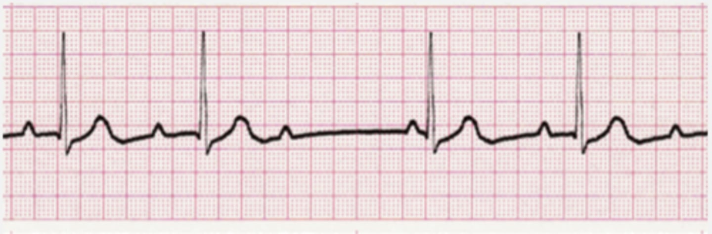 <p>Mobitz type I (Wenckebach) is a heart block described as a regularly irregular beat with a progressive lengthening of PR interval until a beat is “dropped.” Remember: longer, longer, longer drop now you've got a Wenckebach</p>