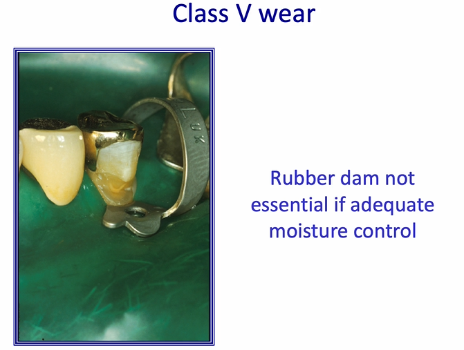 <p>class V wear cavity&nbsp;</p>